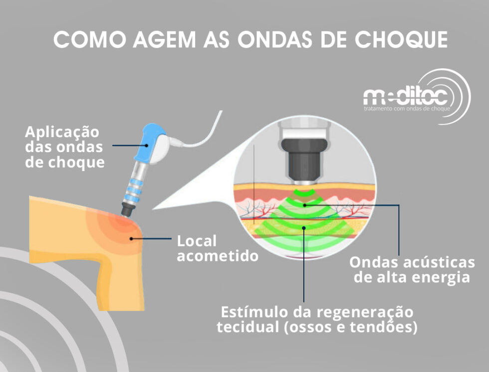 Meditoc Terapia Com Ondas De Choque Ortopro Curitiba